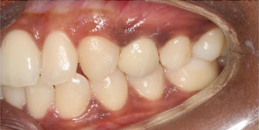 After missing tooth restoration, example photograph.
