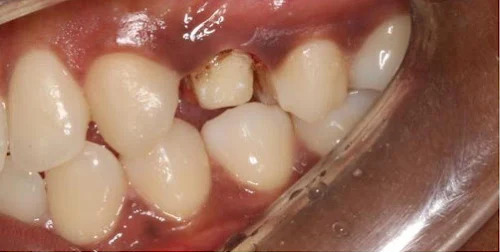 Before missing tooth restoration, example photograph.