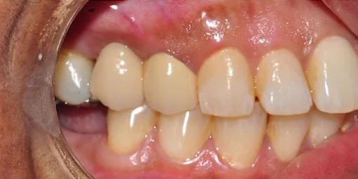After tooth restoration, example photograph.