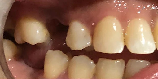 Before tooth restoration, example photograph.