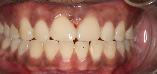 After front tooth gap closure, example photograph.