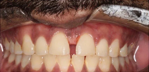 Before front tooth gap closure, example photograph.